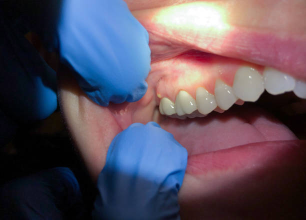 Best Chipped Tooth Repair Near Me  in Colwyn, PA